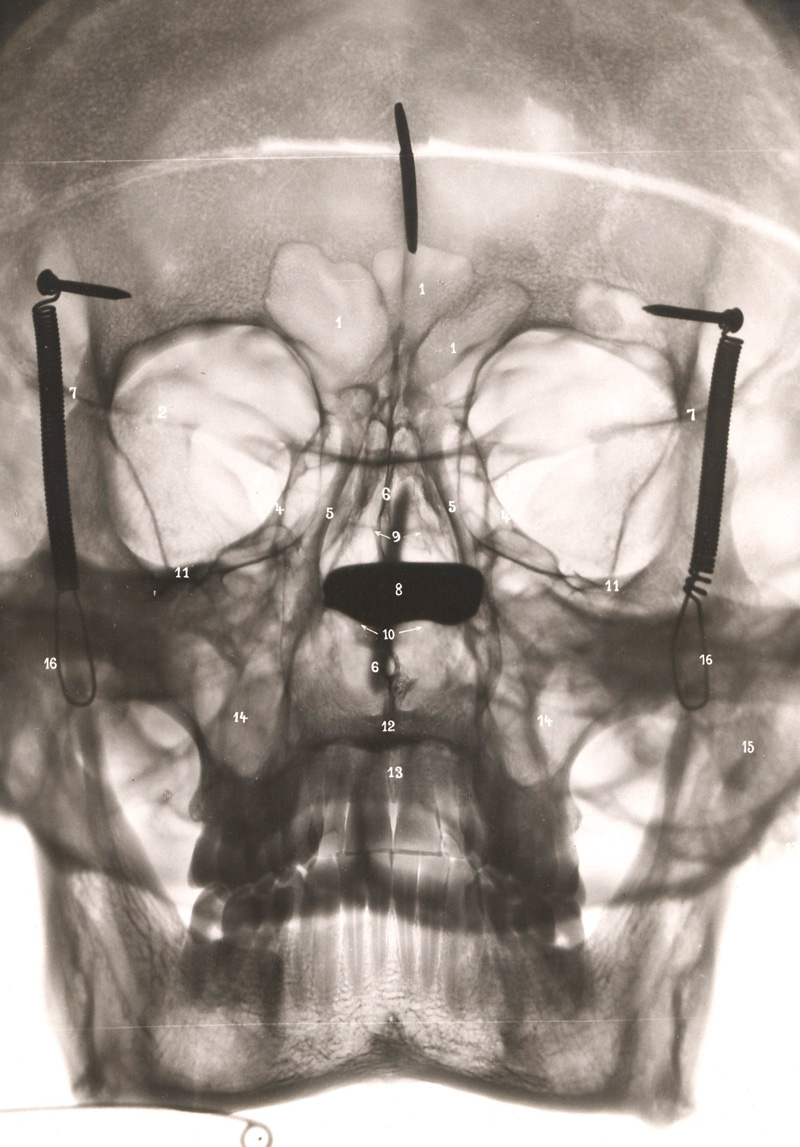 Lot 315, Auction 126, Kuttner, Arthur, Die entzündlichen Nebenhöhlenerkrankungen der Nase im Röntgenbild